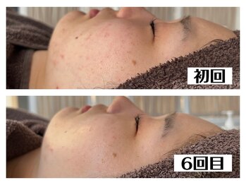 ハオン(HAON)/ハーブピーリング/ニキビ/毛穴