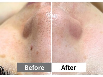 アーキ(ARCHI)/【稲沢/毛穴洗浄】毛穴洗浄