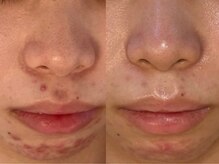 アン(An)/繰り返すニキビのお悩み