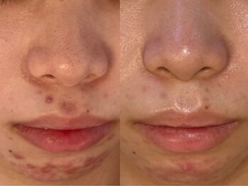 アン(An)/繰り返すニキビのお悩み