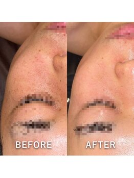 ルアンビューティー メディカルプラス(Luan beauty MEDICAL+)/シミ/美白ケア