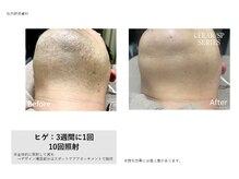 エミュ(emu)/ヒゲ