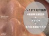 【毛穴徹底ケア】ハイドラ毛穴洗浄×プラズマ×毛穴引き締めマスク¥8500→