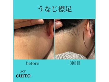 アクト クロ(ACT curro)/【うなじ襟足】脱毛施術例