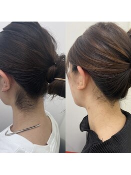 ミース 名古屋駅前店/ ★うなじ脱毛BeforeAfter