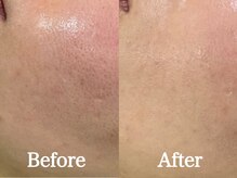 シーベル 小倉/症例写真/ハーブピーリング