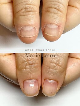 マリーロール 梅田店(Marie Laure)/自爪育成/深爪矯正/ネイルケア