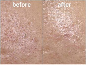 ラティエル(Latiele)/毛穴ケア&透明肌パック