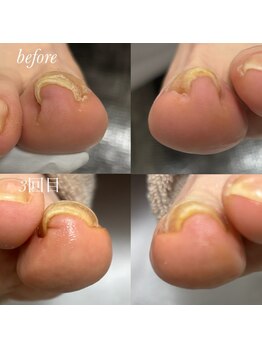 ペディラボ 荻窪店(Pedi Labo)/巻き爪ケア　症例（５）