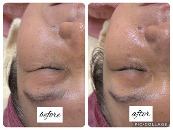 シェービング アンド エステ ローズマリー(Rosemary)/★お顔そりと復元パック★