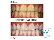 ホワイトニングショップ 甲賀店/Before&After『ホワイトニング』
