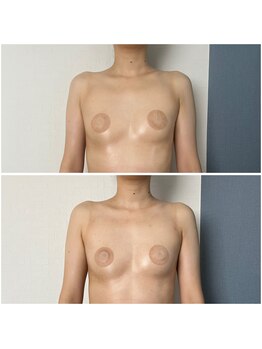 モア(moa)/2回目の変化/バージスライン