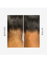 ブランスキンラボ(BLANC.skin LAB)/うなじワックス脱毛