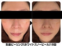 ラディアント たまプラーザ/乳酸ピーリング(スノーピール)