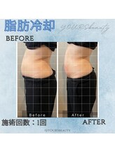 ユアーズ ビューティー(YOURS beauty)/脂肪冷却