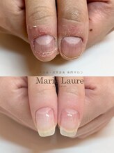 マリーロール 梅田店(Marie Laure)/深爪矯正/自爪育成/自爪風