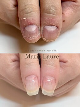 マリーロール 梅田店(Marie Laure)/深爪矯正/自爪育成/自爪風