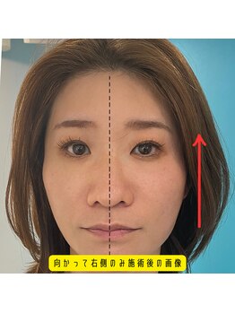 ネクスフィット(Nexfit)/小顔矯正フェイスリフトの効果