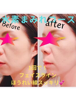 ヨサパーク ライク 板橋店(YOSA PARK LIKE)/水素まみれコース before after