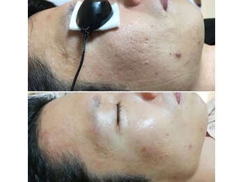 リッチアンビューティー(Rich.an beauty)/カーボンピーリング☆