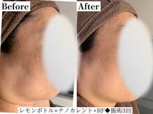 フレイヤ(FREYA)/レモンボトルBefore→After