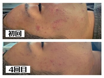 ハオン(HAON)/ハーブピーリング/ニキビ/毛穴