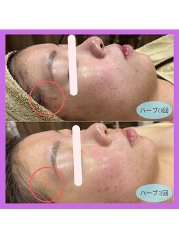 アヴァンス(AVANCE)/ハーブピーリングで健康肌に♪