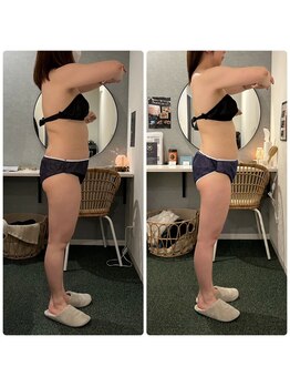 ニコリー(NICOLY)/キャビリポ痩身【120分10回】