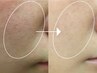 OPEN価格【毛穴ハーブピーリング】剥離なし！毛穴レスな美肌へ¥7500→¥4500