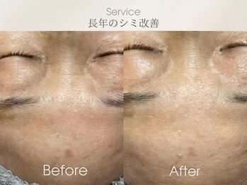フェイシャルサロン ベルダ(BELDA)/【シミケアBefore After】