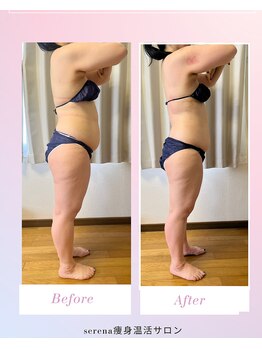 セレーナ(Serena)/4回目施術前後(1回変化)お腹背中