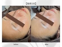 アン ビューティー(ann beauty)/施術【1回】30代