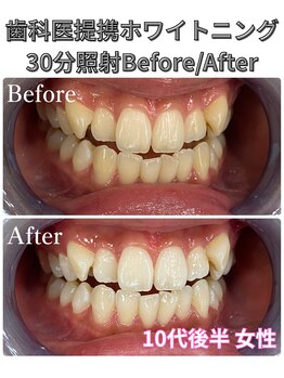 プラチナムビューティ 四条烏丸店(PLATINUM Beauty)/ホワイトニング!Before./After!