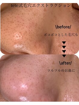 アイシェリー(eyecherie)/毛穴エクストラクション