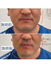 みつばちさろん/【ブラックスタンプ】顔