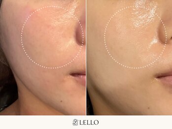 レロ 恵比寿店(LELLO)/ピーリングなのに小顔効果が抜群