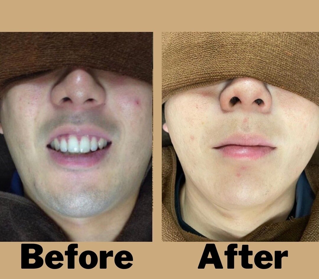 【平日限定】最安！安心の料金変動なし都度払い♪ メンズヒゲ脱毛 \1990 松江