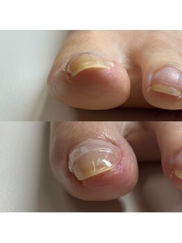 巻き爪矯正3回目(左親指)