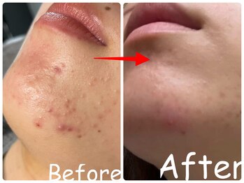 エレ(ele)/剥けるハーブ+剥けないハーブ