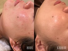 ウォーム(warm)/肌質改善/岡山/フェイシャル