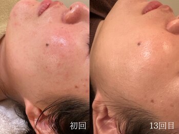 ウォーム(warm)/肌質改善/岡山/フェイシャル