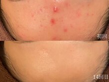 ウォーム(warm)/ニキビケア/肌荒れ/ニキビ肌