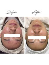 ビズビズ 梅田店(bisebise)/<症例>ニキビケア・赤み