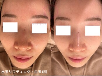 サロンヴェアリー 広尾(salon vary)/赤み・紫外線対策！#水玉#白玉