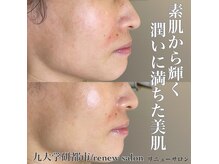 てづか整骨院 西都院/潤う艶肌フェイシャル