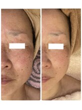 白雲木/シミでお悩みの方