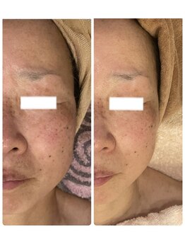 白雲木/シミでお悩みの方