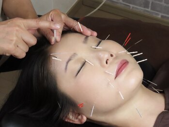 リッチョ鍼灸院(Riccio鍼灸院)/お客様に合わせた箇所に美容施術