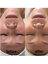 エクレクティック(ECLECTIC)/ハーブピーリング/フェイシャル