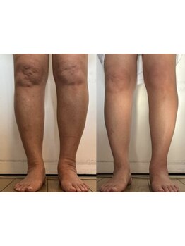 足のむくみを解消したい